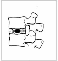Schéma pohybového segmentu a bočního snímku bederní páteře